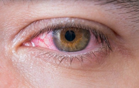 Red irritated eye from ejaculation risk