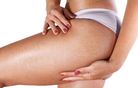 Woman showing natural stretch marks confidently