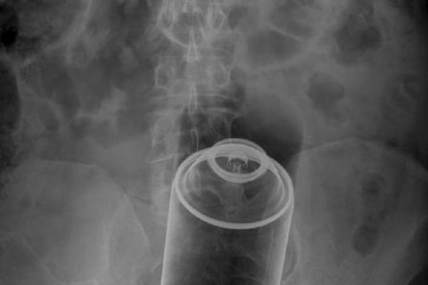 X-ray showing deodorant can in body