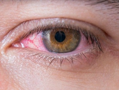 Red irritated eye from ejaculation risk