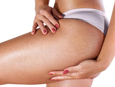 Woman showing natural stretch marks confidently