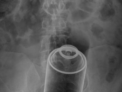 X-ray showing deodorant can in body